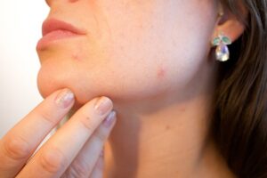 How to Hide a Pimple Without Makeup: 11 Simple Tricks